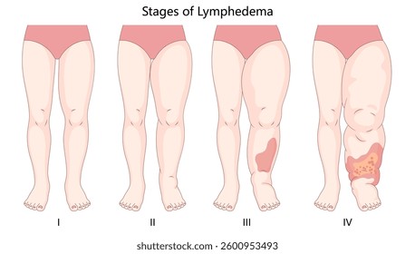 four stages of lymphedema, depicting progressive leg swelling, skin changes, and fluid retention due to lymphatic dysfunction diagram hand drawn vector illustration. Medical science educational
