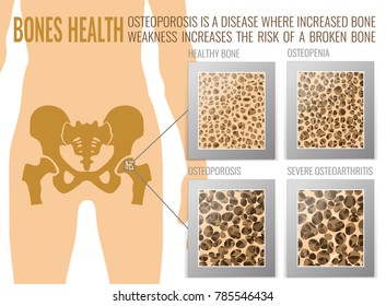 Four stages of osteoporosis. Landscape poster. Osteoporotic bone and healthy bone structure in comparison. Vector illustration useful for medical, educational or scientific graphic design.