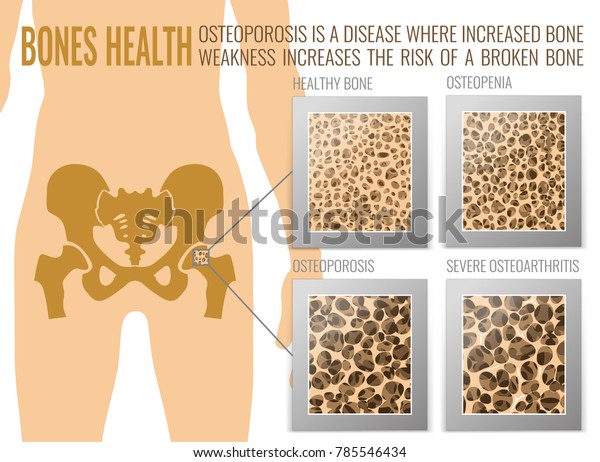 Four Stages Osteoporosis Landscape Poster Osteoporotic Stock Vector