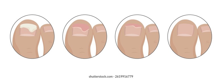 Four steps showing a toenail healing from onycholysis, a medical condition often caused by fungal infections or trauma, highlighting the progressive recovery of a healthy nail