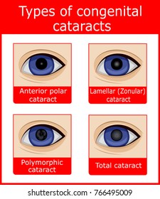 Four types of congenital cataracts, such as anterior polar, lamellar, polymorphic and total