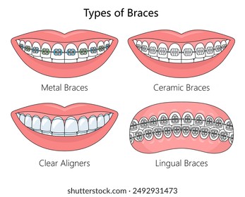 four types of dental braces. Orthodontic options for teeth straightening diagram hand drawn schematic vector illustration. Medical science educational illustration