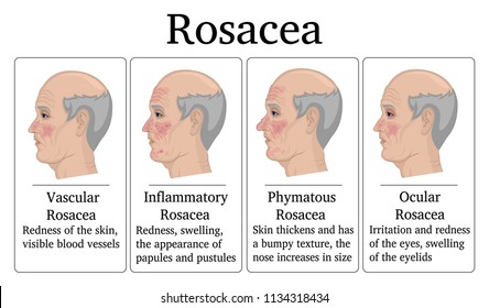 Four types of Rosacea - vascular, inflammatory, phymatous and ocular, for example depicted on the face of an elderly man