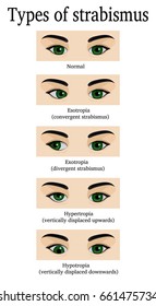 Four types of strabismus: esotropia, exotropia, hydrotropia and hypertropia