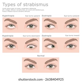 Four types of strabismus and normal human eyes. Vector illustration, medical series. 