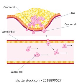 Uma fração das células do tumor primário perde sua aderência a outras células tumorais e ganha a capacidade de penetrar a barreira da membrana basal subjacente ao tecido epitelial