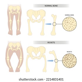 Fracture bone is rickets with x-ray hip low lack of vitamin D and Blount's or Paget's density