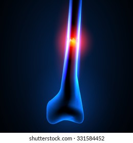 fracture both bone of leg easy editable