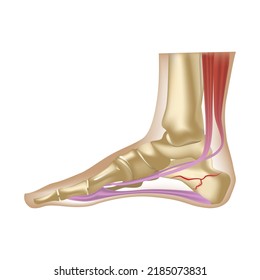 Fracture Calcaneus Human Foot Anatomy Realistic Stock Vector (Royalty ...