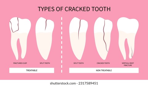 Fracture and grinding pain toothache syndrome teeth crack broken Bad breath in dentistry