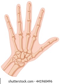 Fracture in human hand illustration