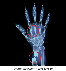 fracture of the metacarpal and radius bones. X-ray of a man's hand. Vector illustration