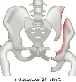 Fracture of the pelvic bone. Realistic rendering of human anatomy. Medical poster, vector illustration