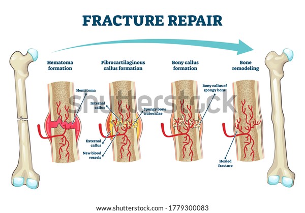 Fracture Repair Educational Bone Remodeling Formation Stock Vector Royalty Free 1779300083