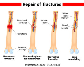 Fracture and repair. Vector scheme