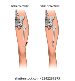 Fracture of the tibia. Two types of fracture. Vector illustration.