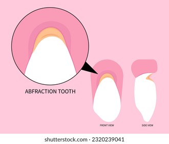 fracture Toothache in dentistry with abfraction disease of teeth crack broken and Bad breath grinding pain syndrome