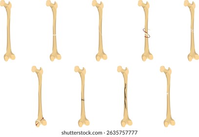 Fracture types refer to the different ways a bone can break due to trauma, stress, or pathological conditions