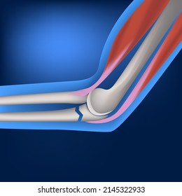 Fracture of the ulna. Anatomy of a human hand on a blue background with indication of bones and muscles. Vector realistic illustration