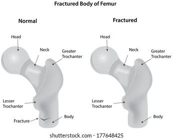 Fractured Body of Femur