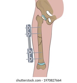 Fractured bone with nails Internal view of leg with nails.