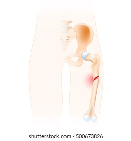 Fractured Femur. Anatomy Of The Hip