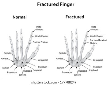 Fractured Finger