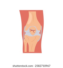 Fractured, Knee, Disability Vector Illustration Isolated