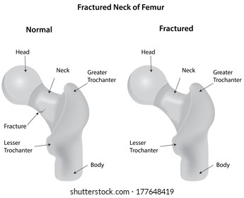 Fractured Neck of Femur