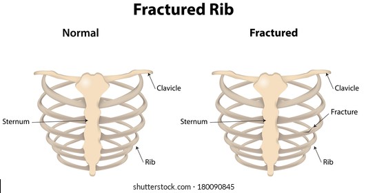 Fractured Rib Labeled Diagram
