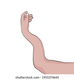 Fractured white man's arm, white background.