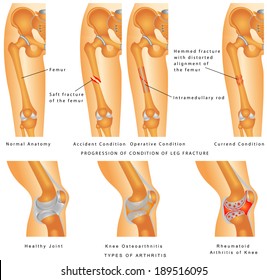 Fractures of Femur. Hemmed fracture with distorted alignment of the femur. Fixation of Femur Fracture with Placement of Intramedullary Rod. Types of Arthritis - Osteoarthritis, Rheumatoid Arthritis svg