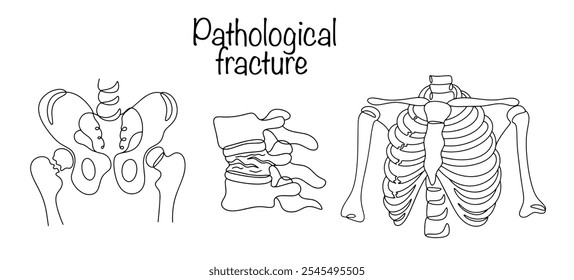 Fraturas que ocorreram sob a influência de força traumática menor ou mesmo na ausência de trauma. Os tipos mais comuns de fratura patológica desenhada com uma linha. Ilustração vetorial.