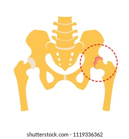 Fragment of the structure of the human skeleton. Pelvic girdle and hips. Coxarthrosis. Destruction of connective cartilaginous tissue. Silhouette. Sign. Vector. Flat design
