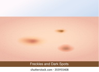 Freckles And Dark Spots On Face Skin. This Illustration About Skin Care And Beauty.