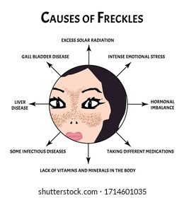 Freckles on the face of the cause. Pigmentation on the skin. A pigmented spot on the skin of the face. Vector illustration