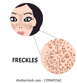 Freckles on the face. Pigmentation on the skin. A pigmented spot on the skin of the face. Before and after treatment. Vector illustration