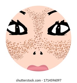 Freckles on the face. Pigmentation on the skin. A pigmented spot on the skin of the face. Before and after treatment. Vector illustration