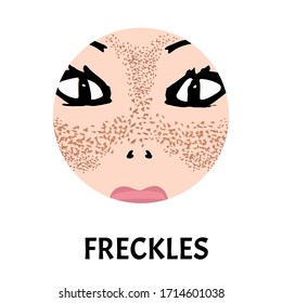 Freckles on the face. Pigmentation on the skin. A pigmented spot on the skin of the face. Before and after treatment. Vector illustration