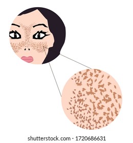 Freckles on the face. Pigmentation on the skin. A pigmented spot on the skin of the face. Before and after treatment. Vector illustration