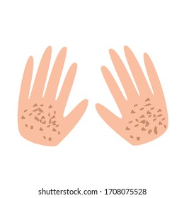 Filas en las manos. Pigmentación en la piel. Un punto pigmentado en la piel de las manos. Ilustración del vector