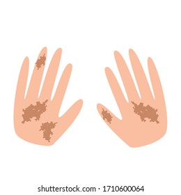 Filas en las manos.Pigmentación en la piel. Un punto pigmentado en la piel de las manos. Ilustración del vector