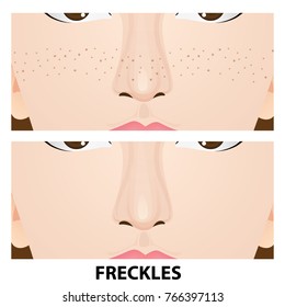 Freckles skin before and after vector illustration