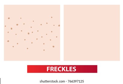 Freckles skin before and after vector illustration