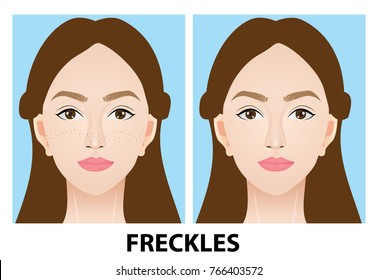 Freckles skin before and after vector illustration