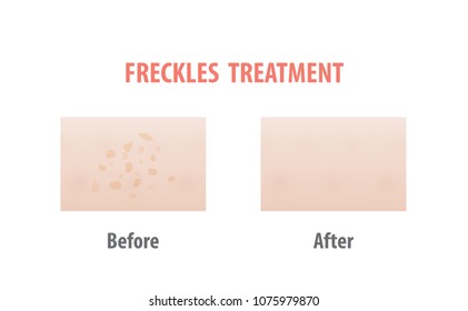 Freckles treatment comparison illustration vector on white background. Skin concept.