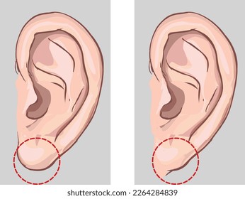 
En comparación, lóbulo de oreja libre y lóbulo de oreja acoplado. ilustración de stock
