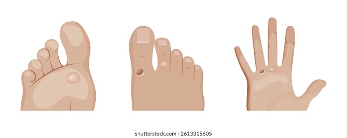 Friction blisters developing on foot and hand skin