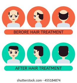 Front, side, back view of a balding man before and after hair treatment and transplantation. Male alopecia set in cartoon style. Perfect for clinics. Vector illustration.