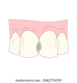Verfall des Vorderzahns. Schmutzige Zähne. Mundgesundheit. Gesundheitsthema. Zahnkaries. Vektorgrafik